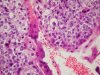 Chorionkarzinom